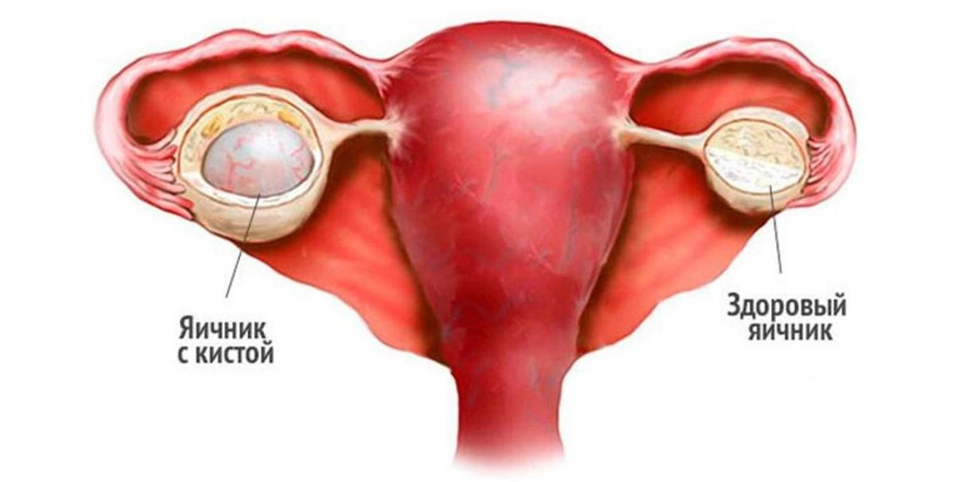 Задержка месячных при кисте яичника