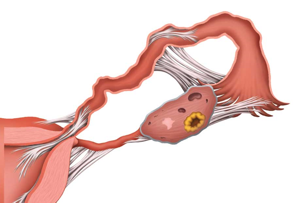 Удаление матки будут ли месячные. Эндометриоз спаечный процесс. Эндометриоз маточных труб. Спаечный процесс в маточных трубах.