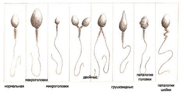 Аномалии в строении сперматозоидов